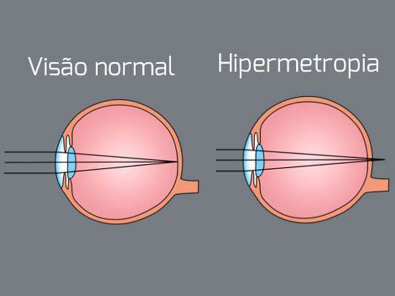 Tratamentos - Hipermetropia